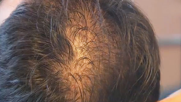 탈모 환자 40는 230대원형탈모가 70