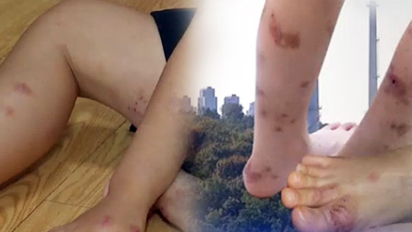 곰팡이 제거주거환경 개선 아토피 치료에 도움