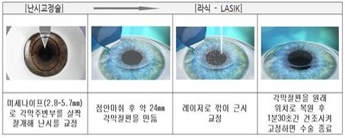 시력교정수술 전 난시교정부터 받는 게 안전