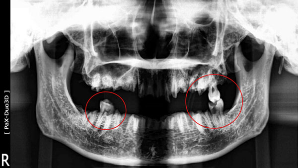 아라뱃길 훼손 시신, 남은 치아 3개 사진도 공개