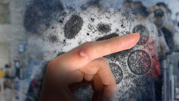 스페인서 원숭이두창 두 번째 사망자 나와