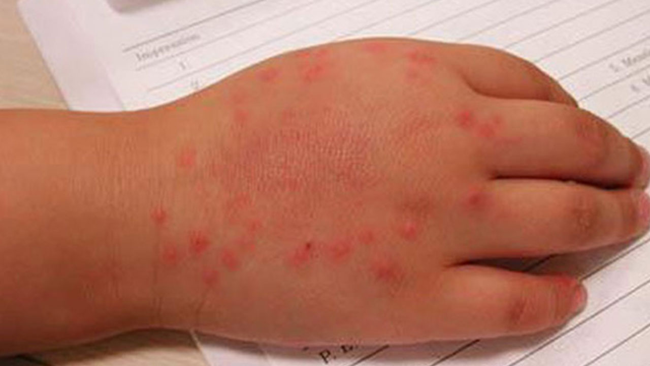 영유아 수족구 대유행‥최근 10년간 최고 수준