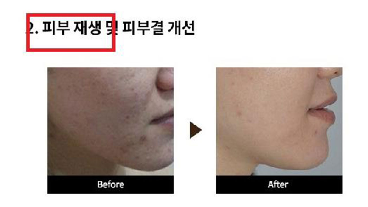 '미세 바늘이 피부 깊숙이 침투' 온라인 부당광고 82건 적발
