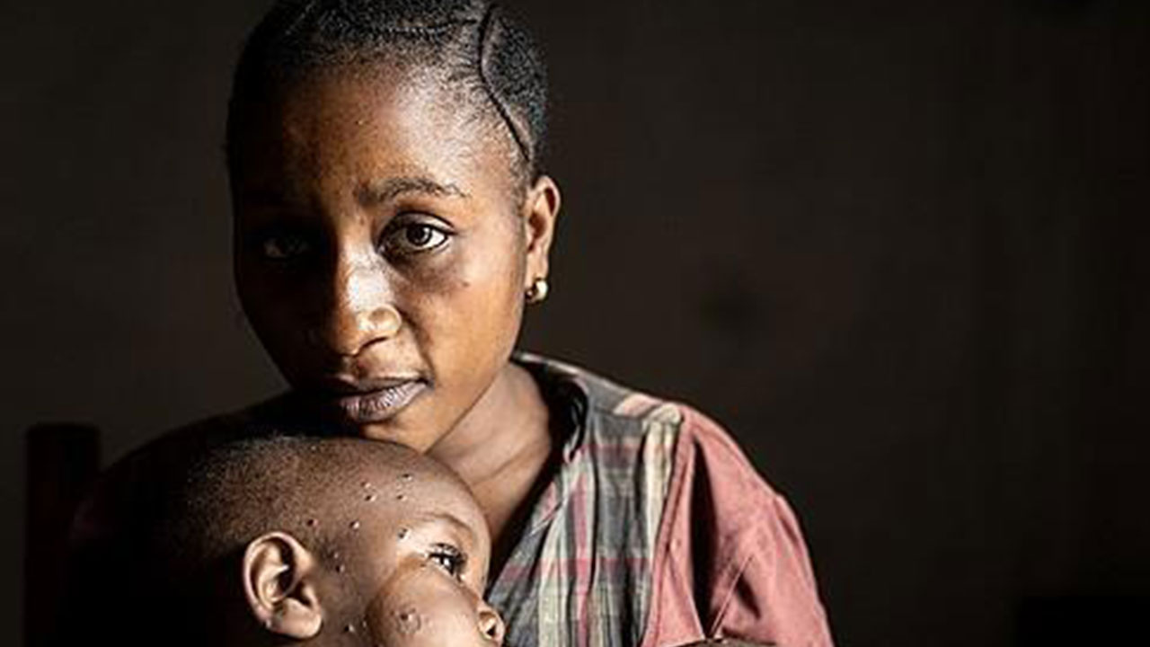 올들어 아프리카서 엠폭스 감염돼 866명 사망