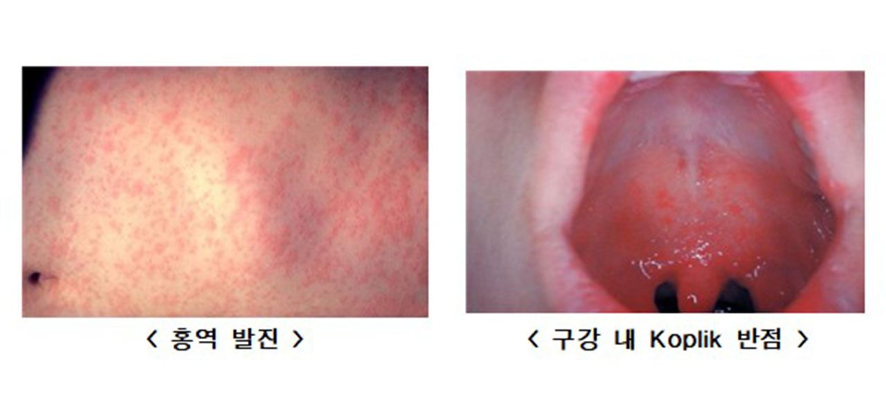 올해 홍역 환자 지난해 1.4배‥"해외여행 전 예방접종해야"