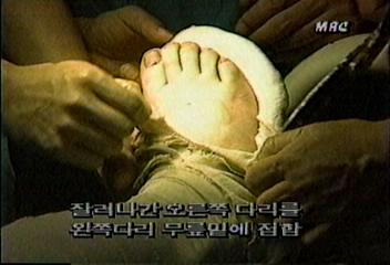 수도권뉴스손상된 다리 봉합수술 성공홍수선