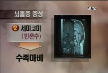 한국인사망 원인 2위인 뇌졸증 단계별 증세지윤태