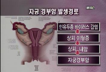 자궁암 예방은 자궁확대경 검사등 정기검진이 최고백지연