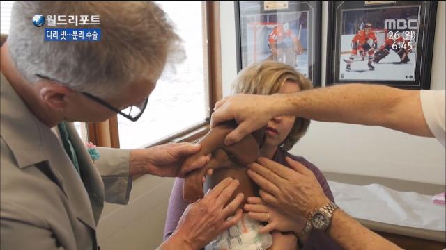 다리 넷 분리 수술 성공