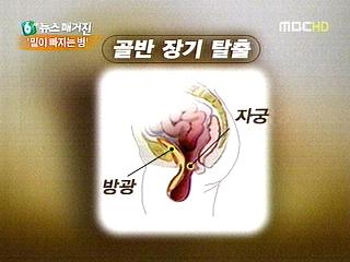 밑이 빠지는 병 숨기지 마세요