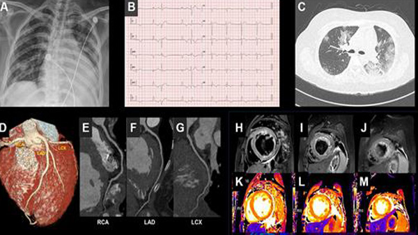 "코로나19가 심장질환 불렀다…21세 여성 국내 첫 사례보고"