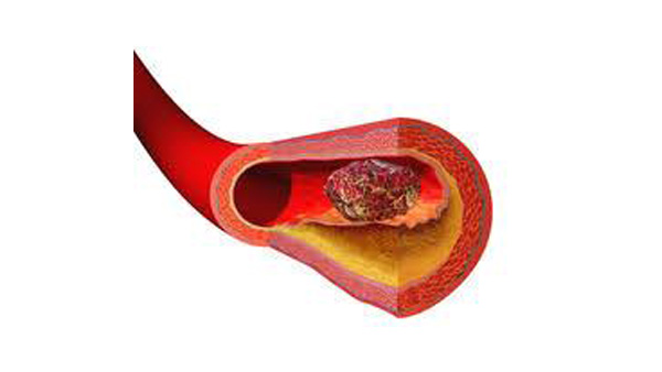 "코로나19, 몸 전체 크고 작은 혈관 막아"