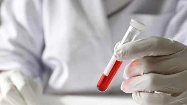 미국 연구팀 "코로나19 증상 악화 예측 혈액 검사법 개발"