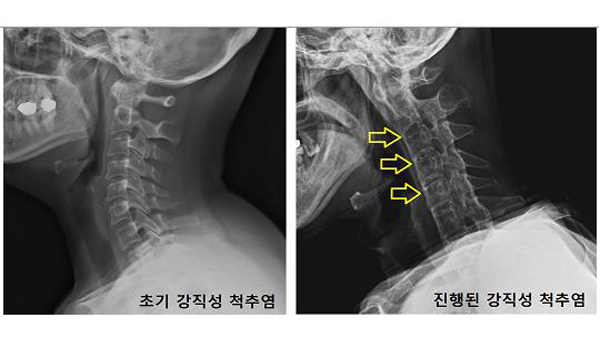 '강직성 척추염' 환자 4년새 20% 증가‥남성이 72%