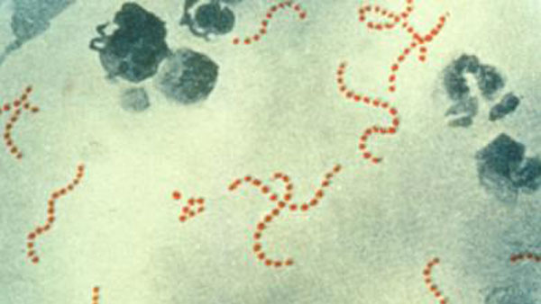 영국에 패혈증 세균 돌림병‥어린이 16명 사망해 비상