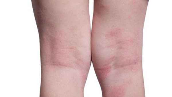 지난해 아토피 환자 증가세 97만여명에 달해