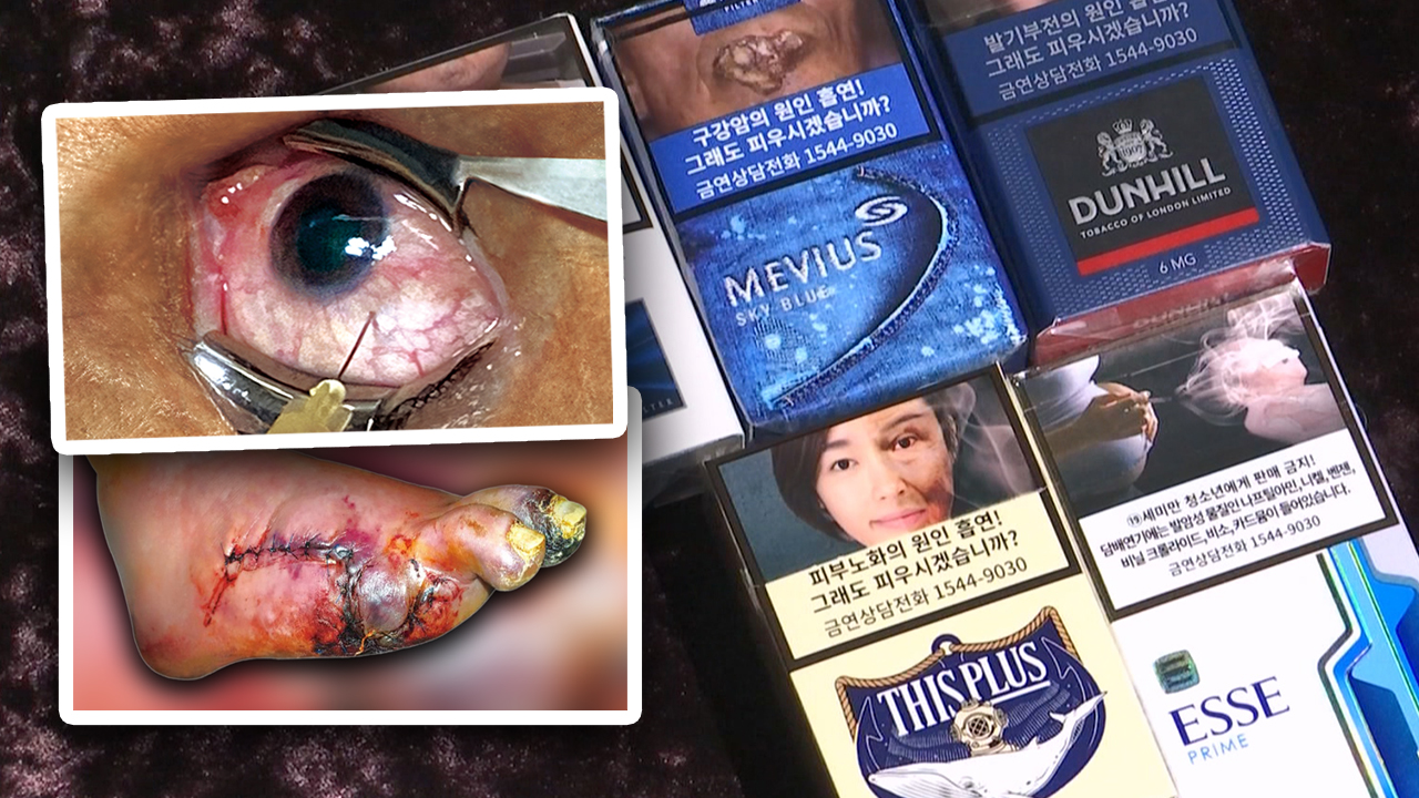 담뱃갑 새 경고그림‥실명·말초질환 그림 추가