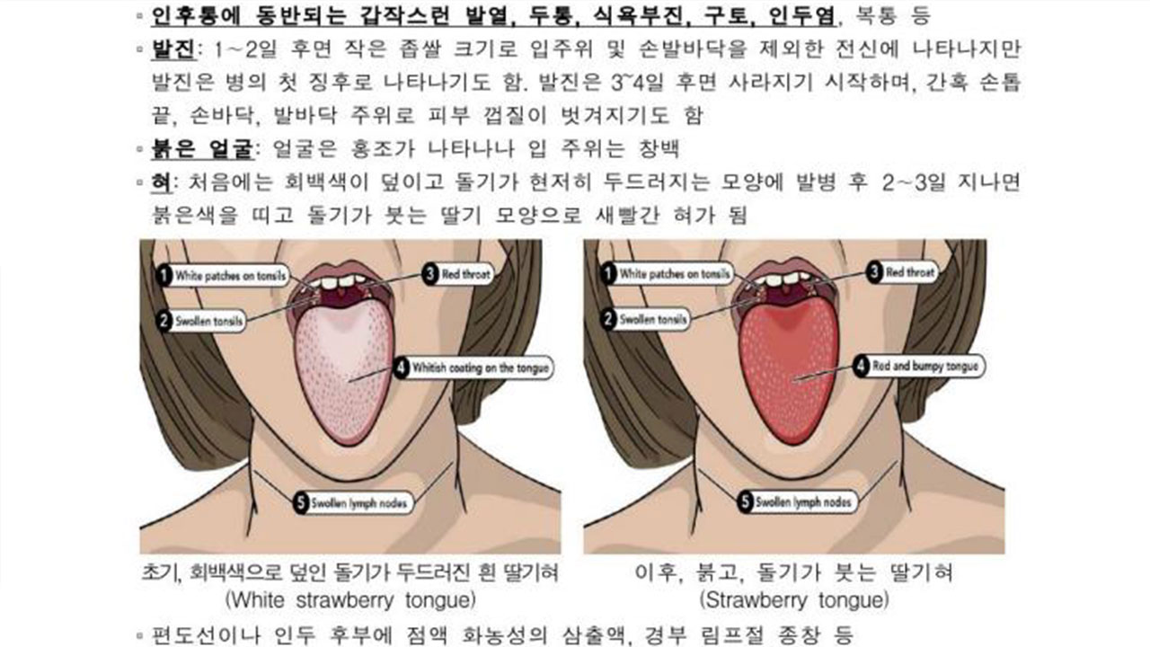 소아 성홍열 유행으로 환자 3천809명‥전년 동기 2.5배