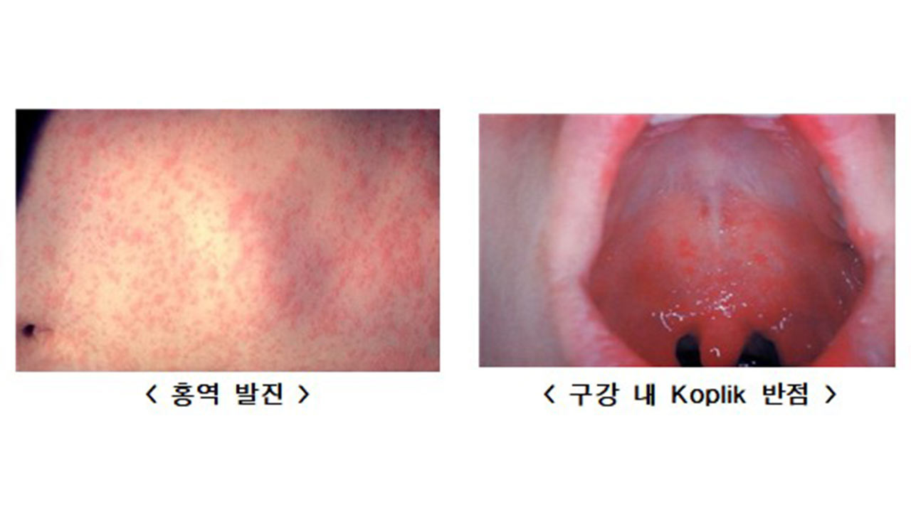 올해 홍역환자 지난해의 1.4배‥"출국 전 예방접종해야" 