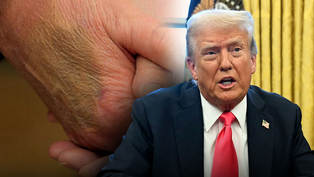 [World Now] 트럼프 오른손 멍자국 설왕설래‥악수탓? 건강 문제?