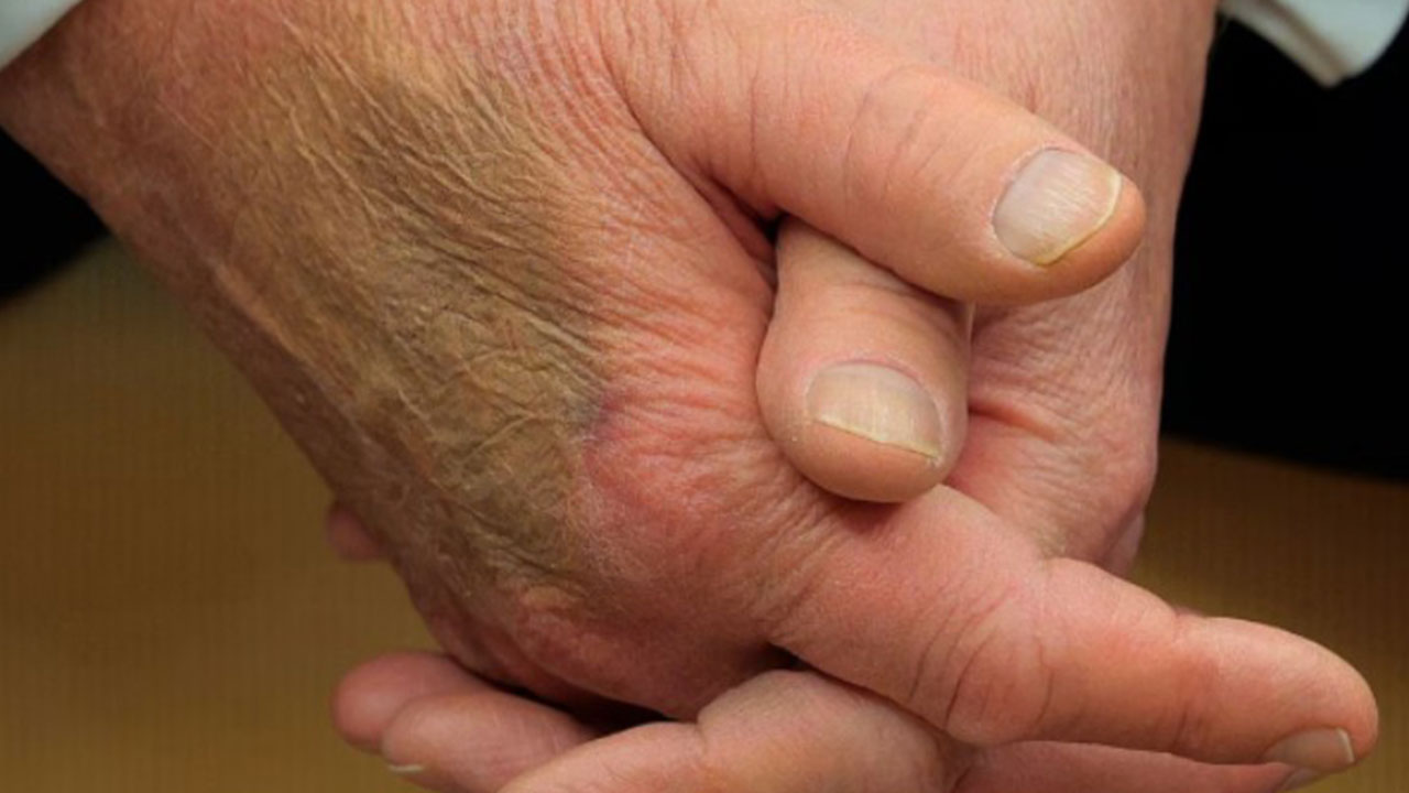 [World Now] 트럼프 오른손 멍자국 설왕설래‥악수탓? 건강 문제?