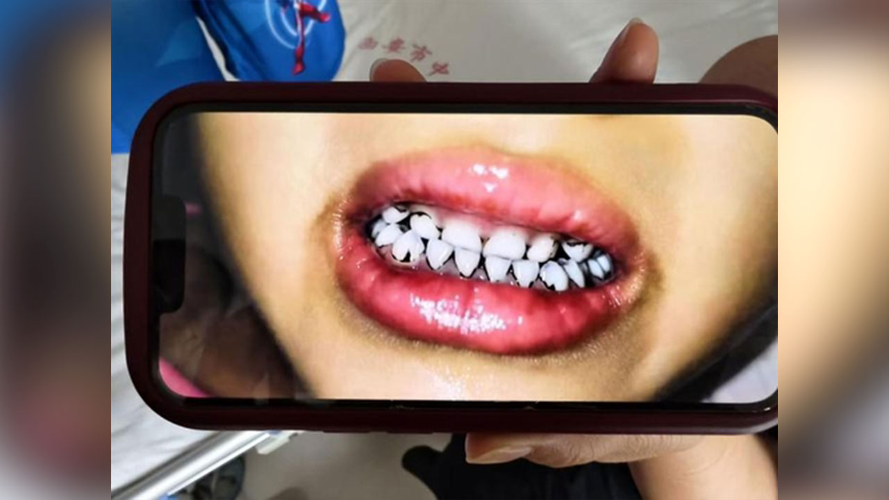 중국에서 유치원생 집단 납중독‥탈모, 치아뿌리 까매져 제독 치료 