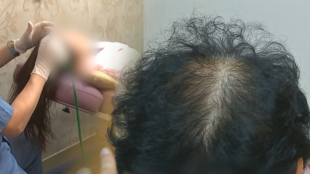 중증 원형 탈모 치료제 건강보험 급여 확대‥선행 치료 실패 시 급여 인정
