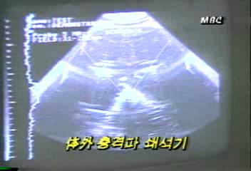 첨단 의료장비 체외 충격파 쇄석기 오늘 축성심경민