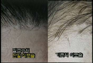 김정철 교수 꺾꽃이식 이식법 머리카락 이식수술 성공이태우