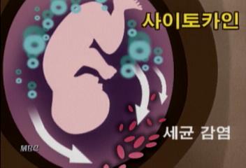 뇌성마비 태아 출산 자궁감염이 원인지윤태