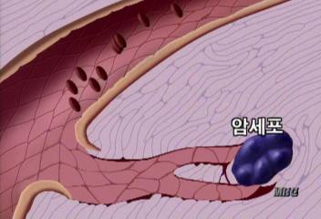 암 정복 멀지 않았다황희만