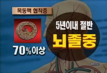 뇌졸중 고혈압 당뇨 부정맥 원인 검사로 조기 치료정규철