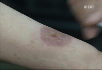 45월 봄철 자외선 계속쬐면 피부암 전단계인 광선각화증 위험조문기