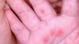 영유아 수족구병 고온 탓에 일찍 유행합병증 주의 요구