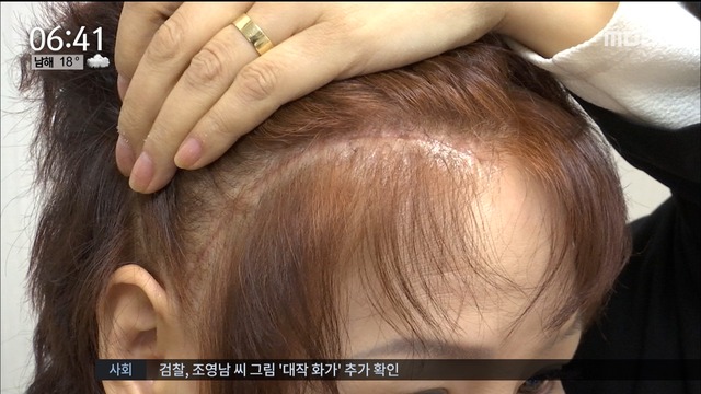 아이에게 물대포를 쏜 한강 제트스키가 날아간 아이의 머리 수술을 받았다 2