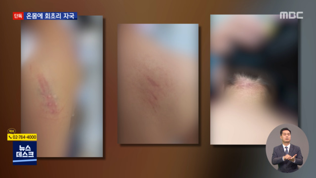 단독 9살 장애아 몸에 선명한 매 자국바닥쳤는데 맞았다