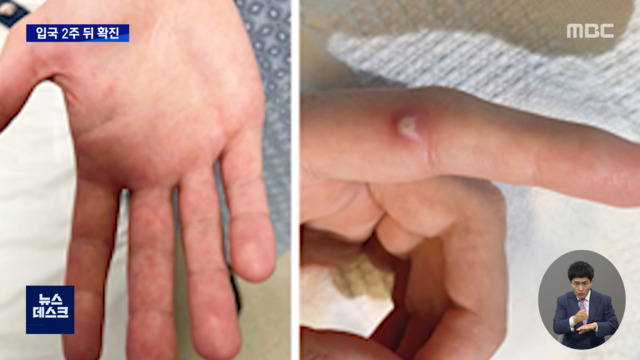  두 번째 원숭이두창 환자 발생"지역전파 가능성 낮아"