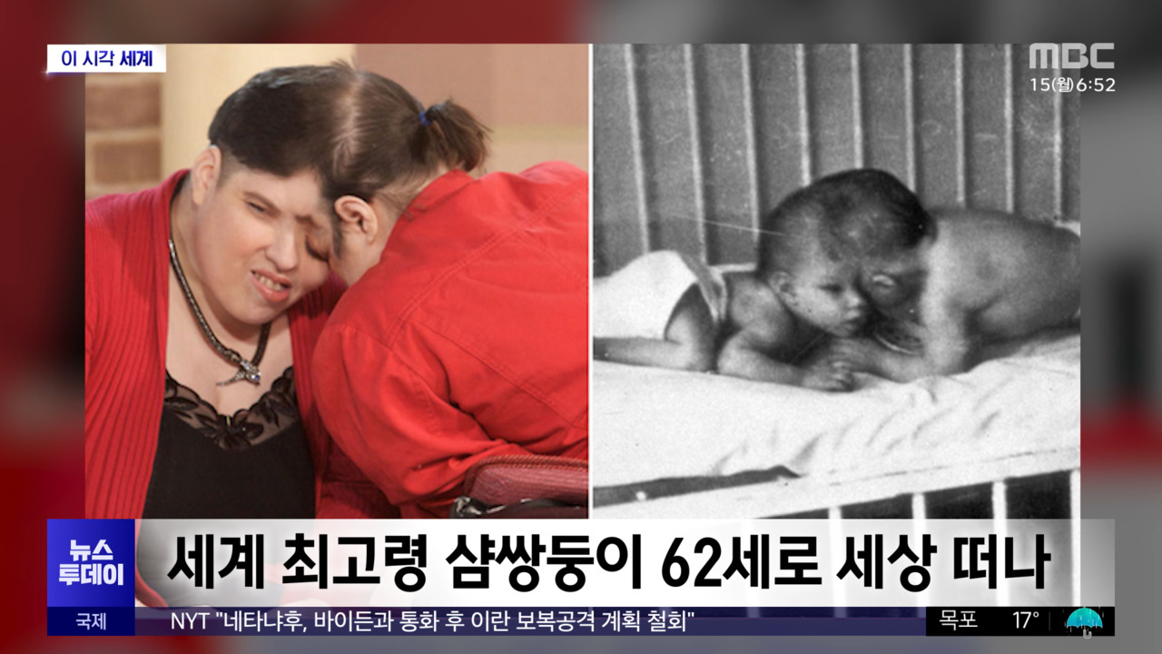 [이 시각 세계] 세계 최고령 샴쌍둥이 62세로 세상 떠나